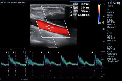 Value of carotid corrected flow time or changes value of FTc could be more useful in predicting fluid responsiveness in patients undergoing robot-assisted gynecologic surgery: a prospective observational study